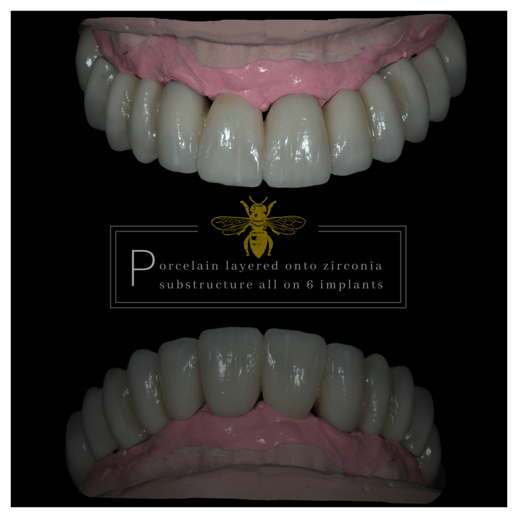 An upper denture showing a set of teeth made from porcelain layered onto zirconia substructure.