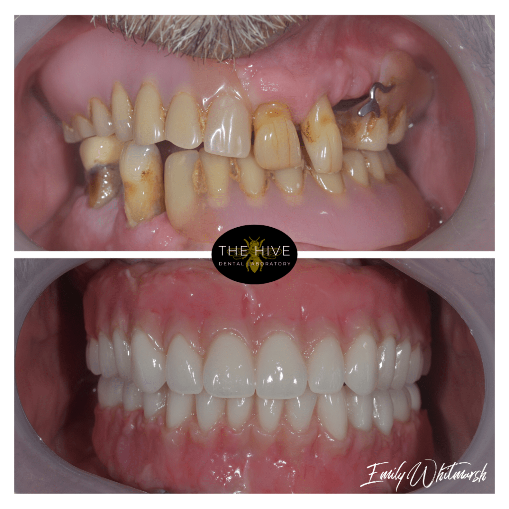 A before and after photo of a mouth. Before teeth are miscoloured and uneven, while the after is of a bright white smile.