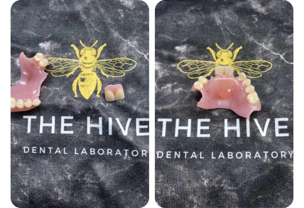 Broken acrylic denture repaired in our mobile dental laboratory on the same day