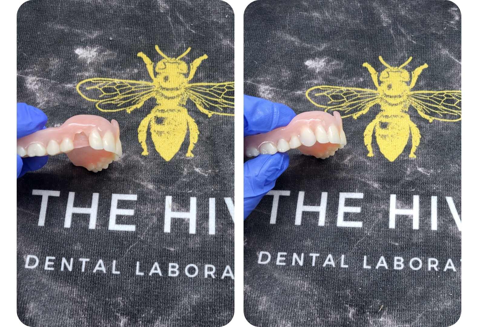 Denture Repair Broken Tooth from Acrylic Denture